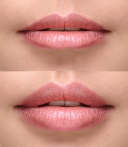 Russian Lips und Lippen aufspritzen